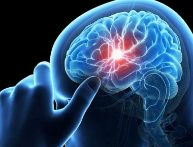 Εγκεφαλικό επεισόδιο: Ακόμα και σε πολύ χαμηλές τιμές η «κακή» χοληστερίνη αυξάνει τον κίνδυνο